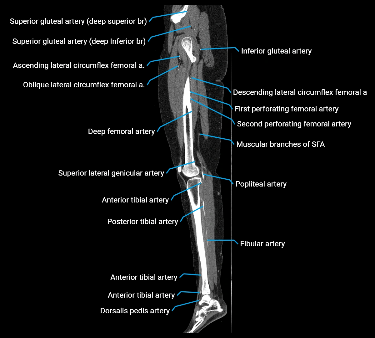 CTA lower limb sagittal cross sectional anatomy labelled image _47 (3).webp